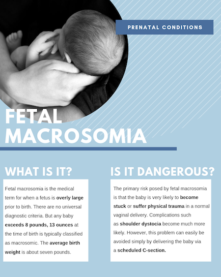 Fetal Macrosomia Infographic
