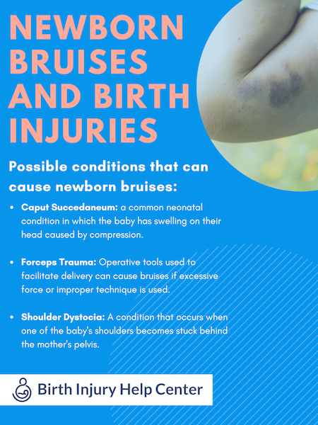 Newborn Bruises Birth Injury Infographic