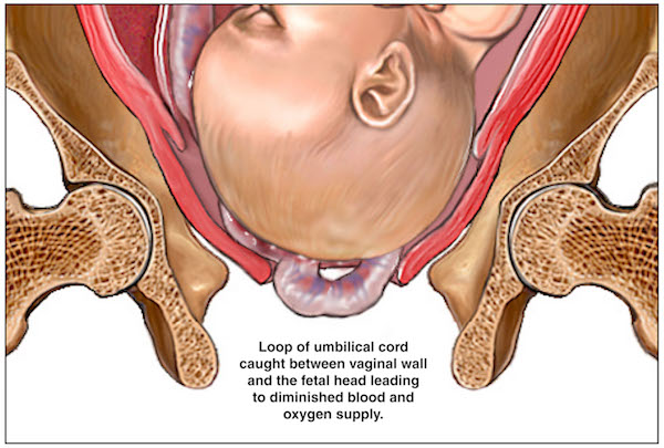 What is an umbilical prolapse is and the causes and treatment for the obstetrical emergency.