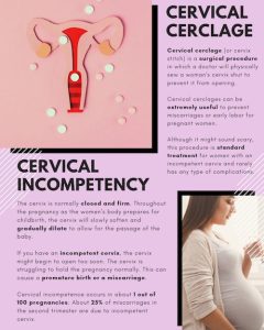 Cervical Cerclage During Pregnancy